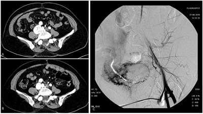 Intravenous Leiomyomatosis Complicated by Arteriovenous Fistula: Case Series and Literature Review